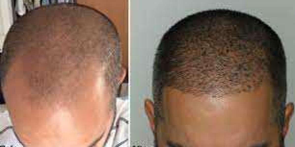PRP for Hair Loss Before and After