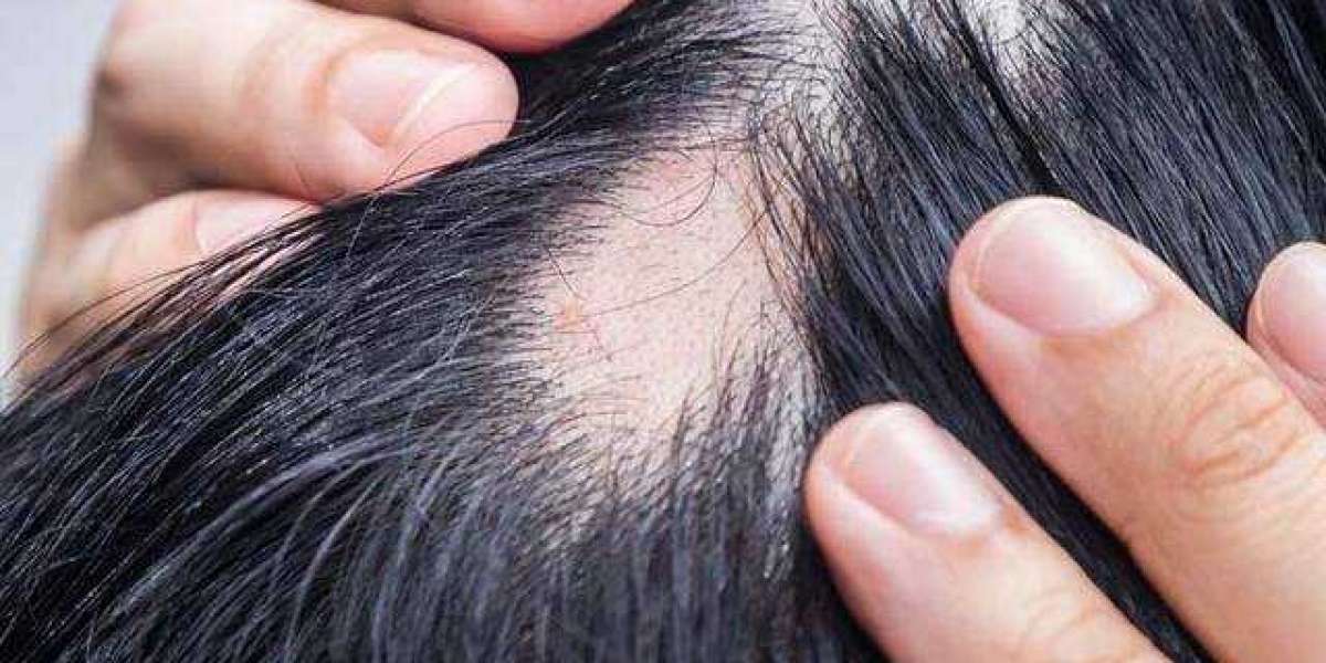 What causes Baldness