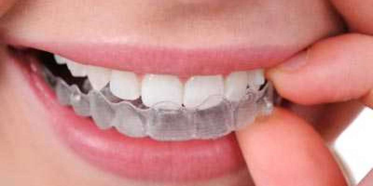 How Much Do Teeth Aligners Cost in India - Teeth Aligners