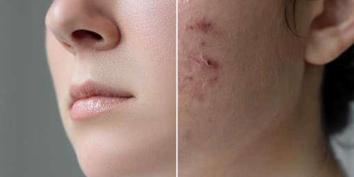 Need Some Help With Your Acne? Try Using These Tips!
