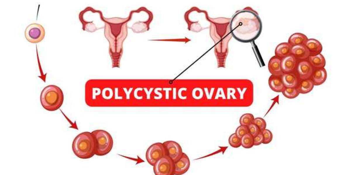 POLYCYSTIC OVARIES – WHAT ONE SHOULD KNOW?